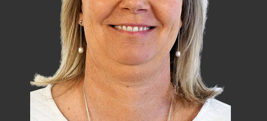 Fedtsugning af hals hos Bonnie